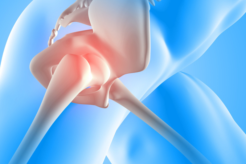 Hip Replacement Surgery in India: How It Works & Recovery Timeline
