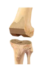 Knee Replacement Surgery
