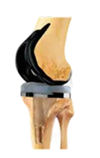 Knee Replacement Surgery Cost