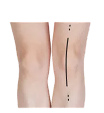 Best Doctor For Knee Replacement In Jaipur